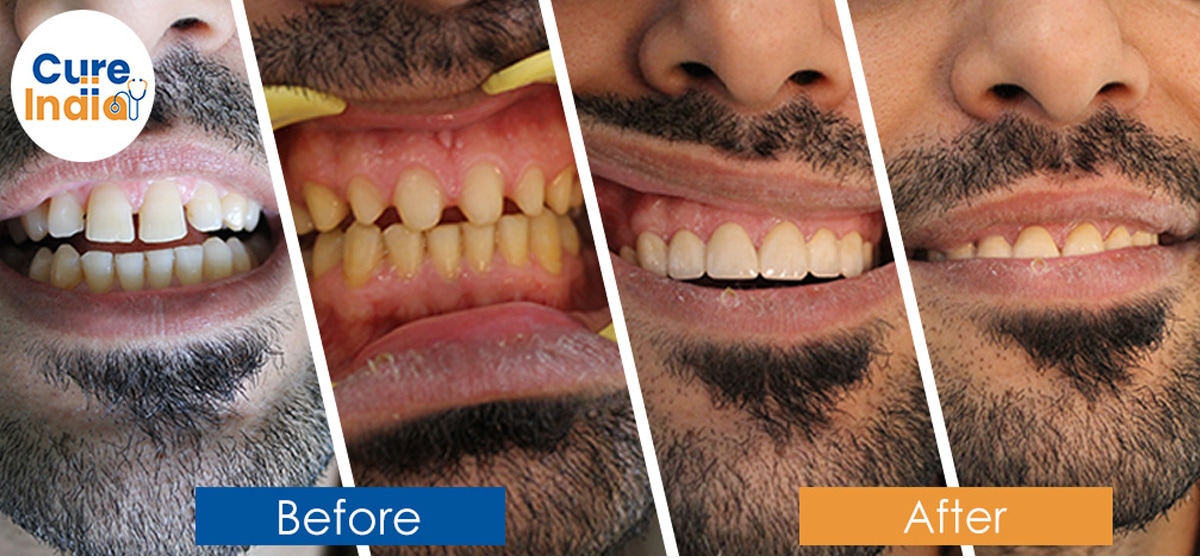 Dental Crown Before and After Case 5